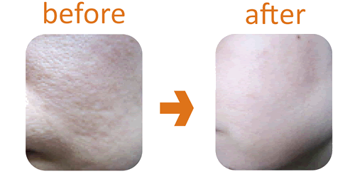 �n�[�u�����f�B�r�t�H�[�A�t�^�[